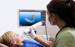 digital-impression-for-dentistry