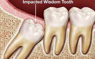 wisdom tooth